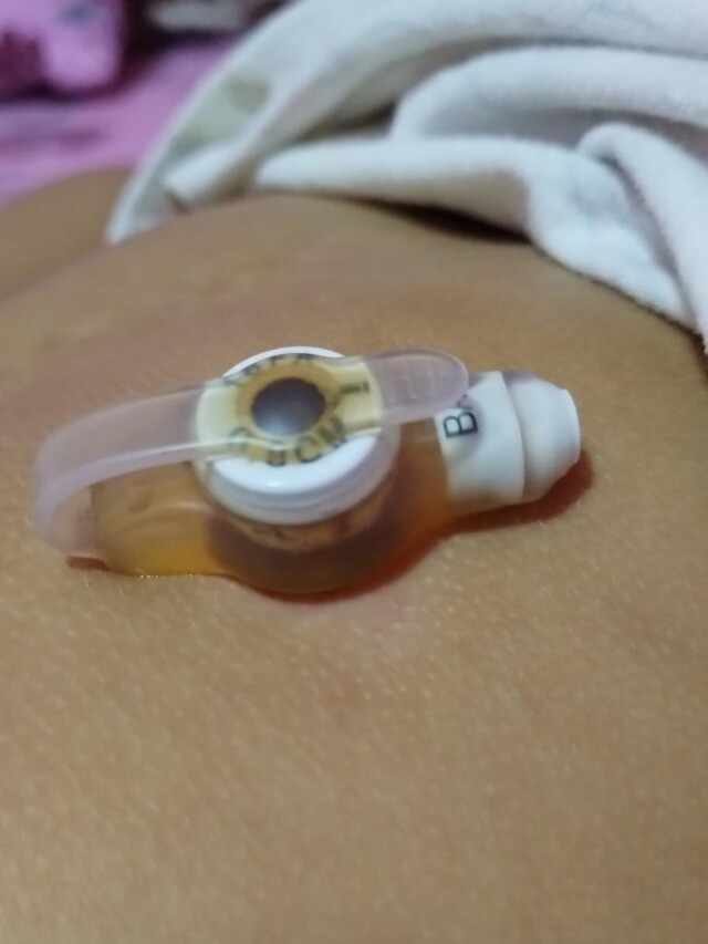 O botton é um dispositivo de silicone que fica na região do abdômen da menina (Foto: Arquivo Pessoal) 
