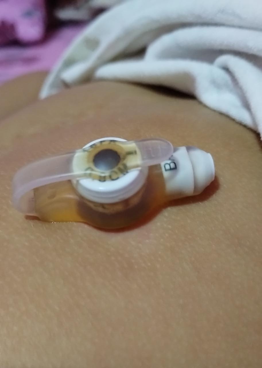 O botton é um dispositivo de silicone que fica na região do abdômen da menina (Foto: Arquivo Pessoal) O botton é um dispositivo de silicone que fica na região do abdômen da menina (Foto: Arquivo Pessoal)
