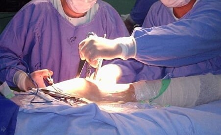 Médico explica causa da complicação que matou mulher que fez lipoaspiração em clínica clandestina. Foto; Reprodução/Internet Médico explica causa da complicação que matou mulher que fez lipoaspiração em clínica clandestina. Foto; Reprodução/Internet