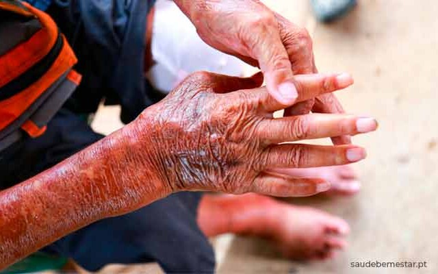 Esclerodermia afeta mais as mulheres