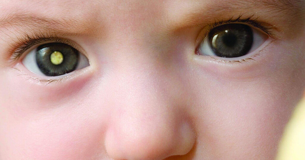 O retinoblastoma é um tumor maligno originário das células da retina, que é a parte do olho responsável pela visão, afetando um ou ambos os olhos (Foto: Reprodução/Internet) O retinoblastoma é um tumor maligno originário das células da retina, que é a parte do olho responsável pela visão, afetando um ou ambos os olhos (Foto: Reprodução/Internet)