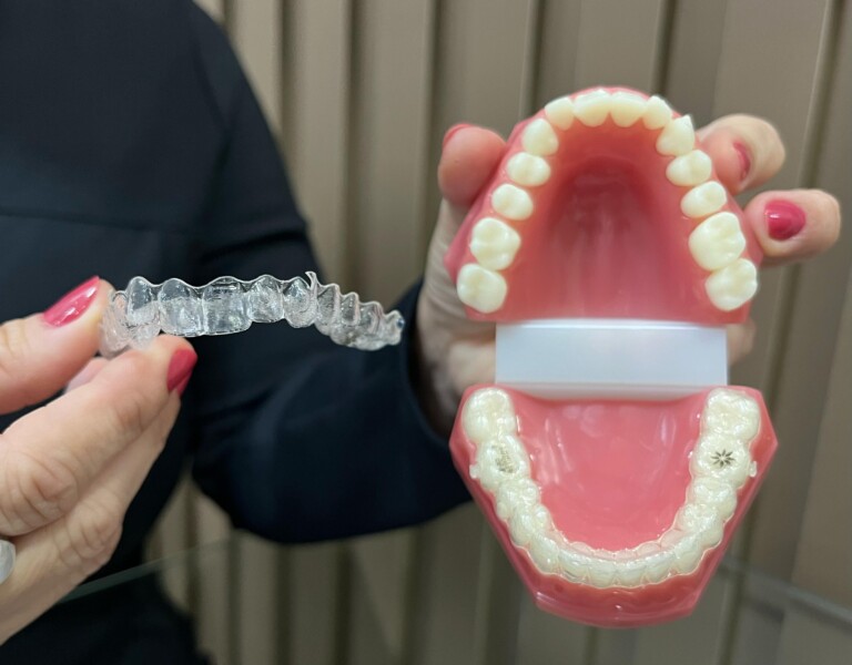 Alinhadores se mostram opções mais rápidas, discretas e previsíveis de tratamento ortodôntico (Foto: Redação/FolhaBV)