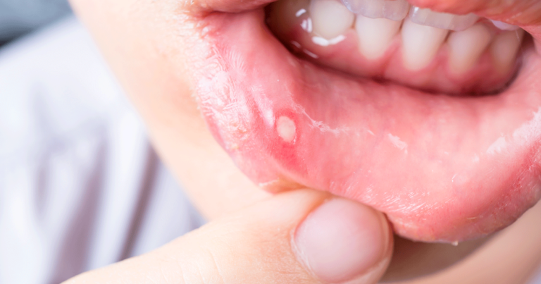 Aftas podem piorar conforme a mucosa da boca se torna mais ácida - Foto: Reprodução/Internet.