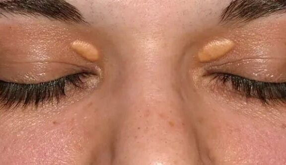 Xantelasma e xantoma