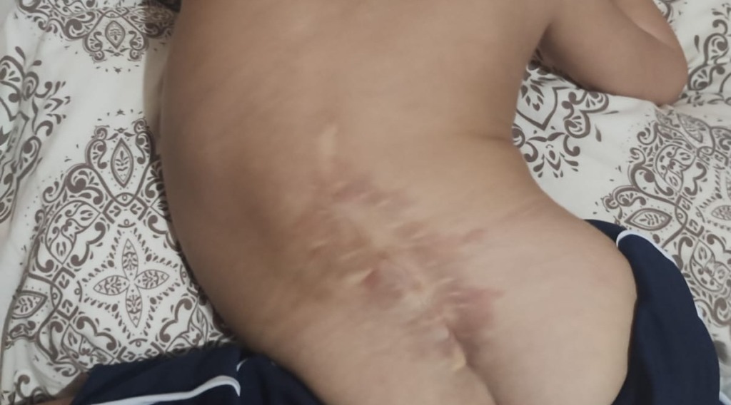 Benjamin precisará passar por uma cirurgia em outro estado para corrigir a escoliose, um dos problemas decorrente da Mielomeningocele. (Foto: Arquivo pessoal) Benjamin precisará passar por uma cirurgia em outro estado para corrigir a escoliose, um dos problemas decorrente da Mielomeningocele. (Foto: Arquivo pessoal)