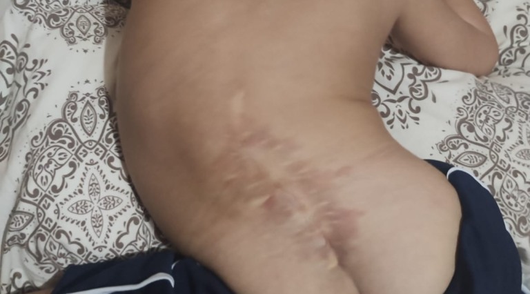 Benjamin precisará passar por uma cirurgia em outro estado para corrigir a escoliose, um dos problemas decorrente da Mielomeningocele. (Foto: Arquivo pessoal)