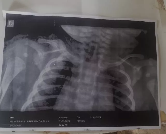 Mãe denuncia negligência médica após filho ter clavícula quebrada durante o parto