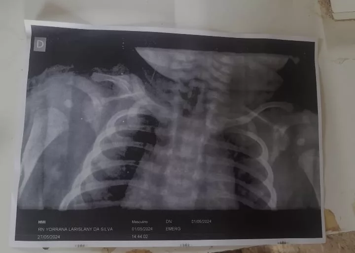 Mãe denuncia negligência médica após filho ter clavícula quebrada durante o parto