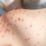 Mais de 1,5 mil casos de mpox foram contabilizados no Brasil em 2024