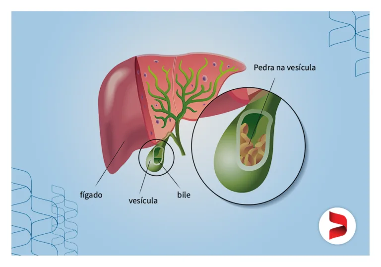 Litíase Biliar