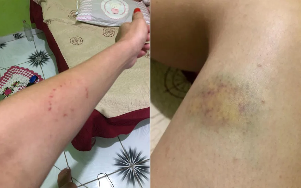 Marcas das agressões no corpo da jovem (Foto: Arquivo pessoal)