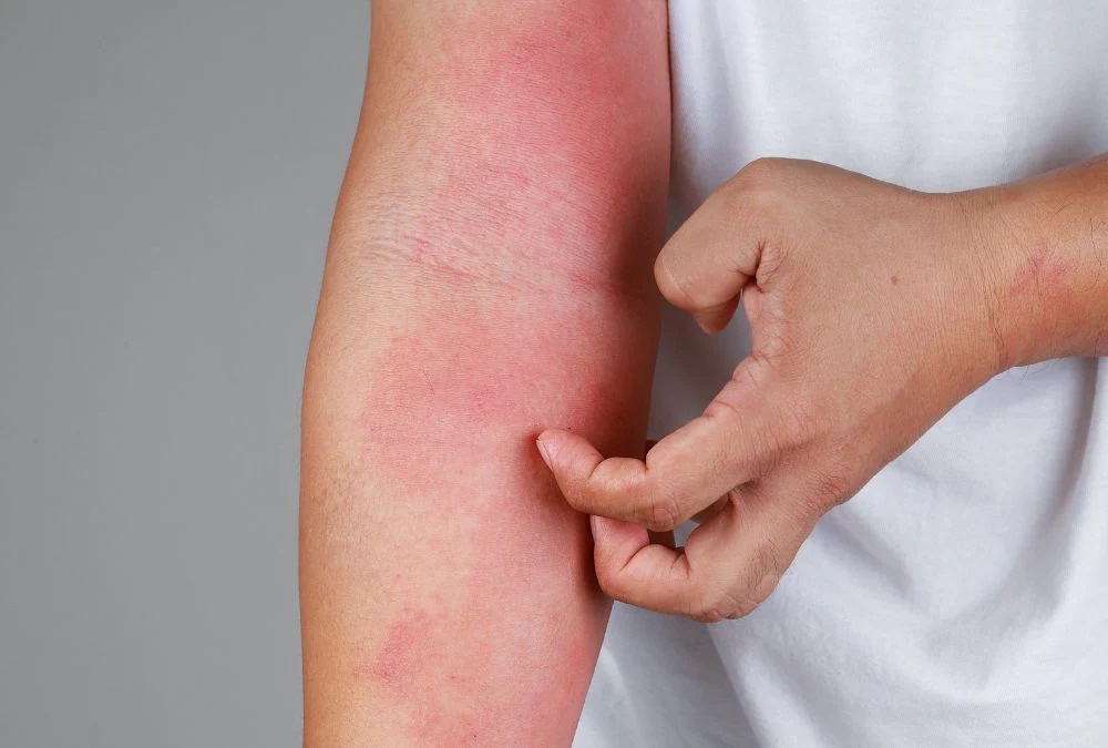 SUS oferece novos medicamentos de dermatite atópica