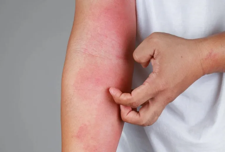 SUS oferece novos medicamentos de dermatite atópica