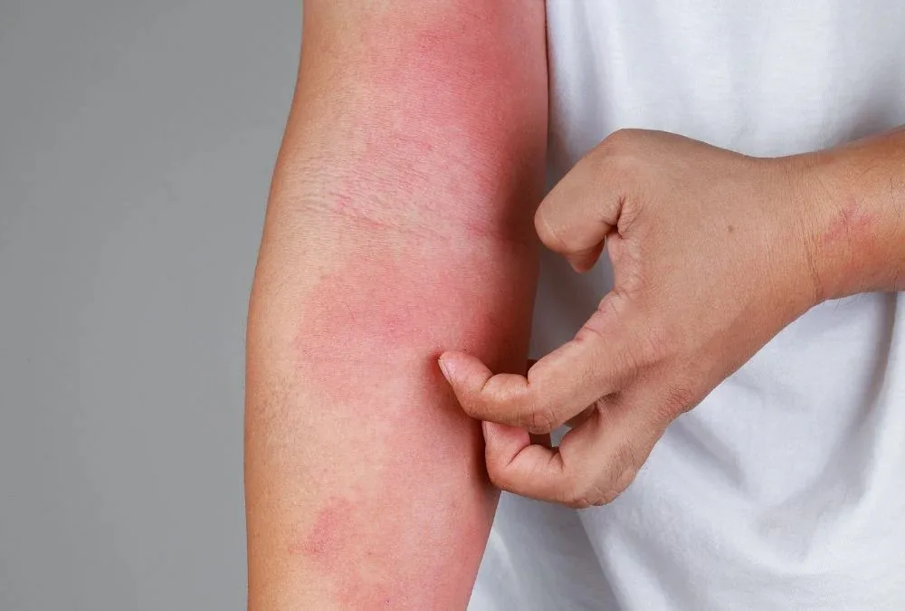 SUS oferece novos medicamentos de dermatite atópica