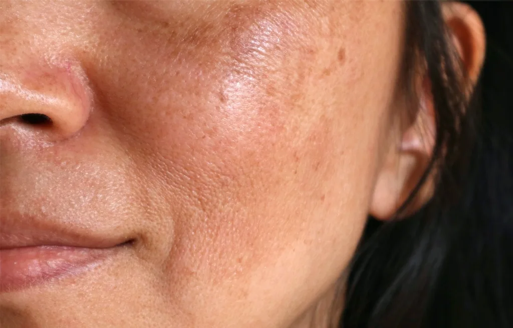 Isso acontece porque o calor estimula as células chamadas melanócitos (Foto: Divulgação) Isso acontece porque o calor estimula as células chamadas melanócitos (Foto: Divulgação)