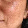 Isso acontece porque o calor estimula as células chamadas melanócitos  (Foto: Divulgação)