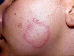 Dermatofitose