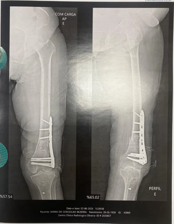 Raio-X de cirurgia corrigida pela Medtrauma