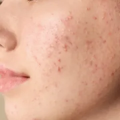 Acne: Um problema de pele que vai além da adolescência
