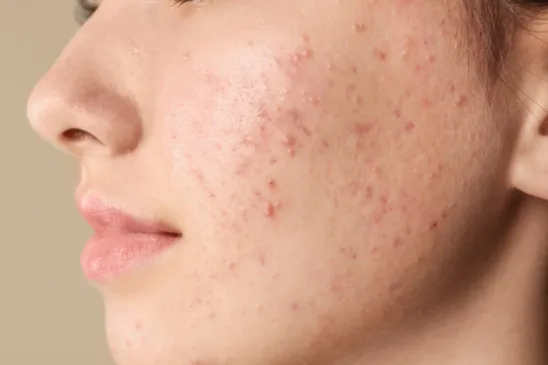 Acne: Um problema de pele que vai além da adolescência