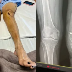 Estado da perna de Maria da Conceição Bezerra após cirurgia da Medtrauma