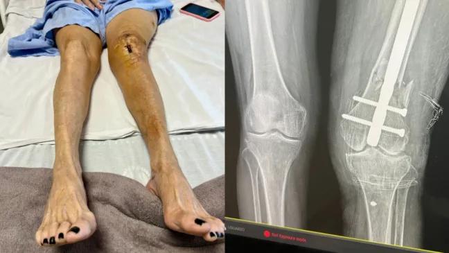 Estado da perna de Maria da Conceição Bezerra após cirurgia da Medtrauma
