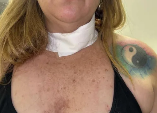 A vítima precisou passar por uma cirurgia para colocar uma traqueostomia (Foto: Divulgação) 