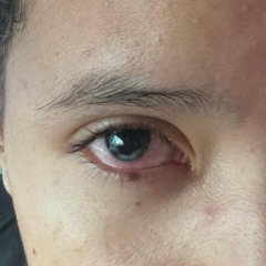 CIRURGIA NO OLHO PALOMA HADASSA