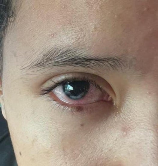 CIRURGIA NO OLHO PALOMA HADASSA