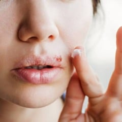 Doença do beijo