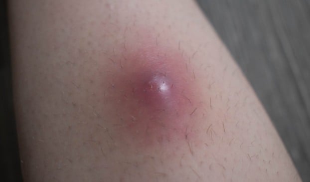 Um furúnculo é causado pela bactéria Staphylococcus aureus, que entra na pele por pequenos cortes, arranhões ou folículos inflamados. (Foto: Reprodução/Vitat)