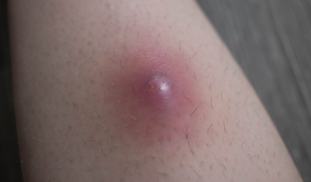 Um furúnculo é causado pela bactéria Staphylococcus aureus, que entra na pele por pequenos cortes, arranhões ou folículos inflamados. (Foto: Reprodução/Vitat)