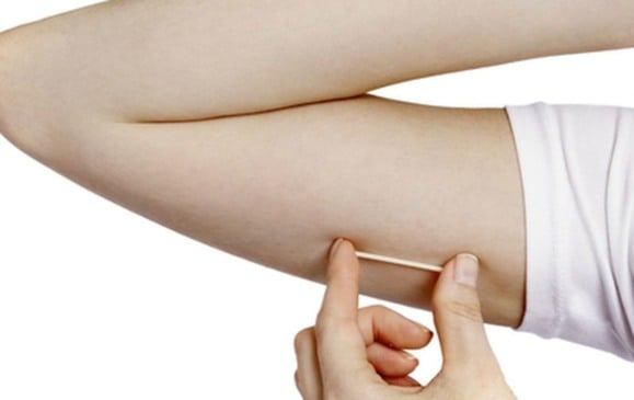 O implante subdérmico atua por até três anos, sem necessidade de manutenção. (Foto: Reprodução/Internet)