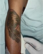 Paciente possui uma tatuagem no braço direito com o desenho semelhante a uma águia.