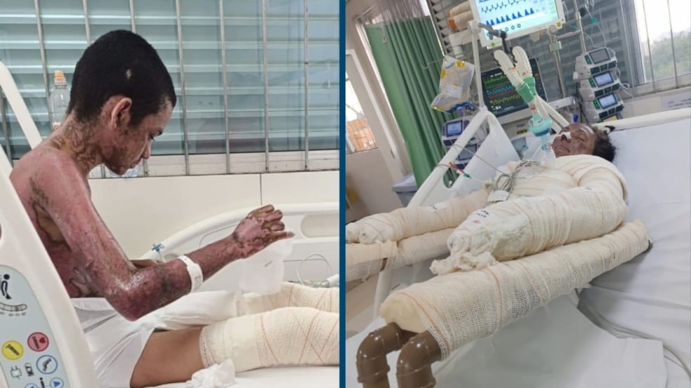 Mãe e filho em diferentes etapas de recuperação após a explosão de gás que atingiu a família em Boa Vista; ela segue na UTI, e ele realiza tratamento ambulatorial. (Foto: Divulgação)