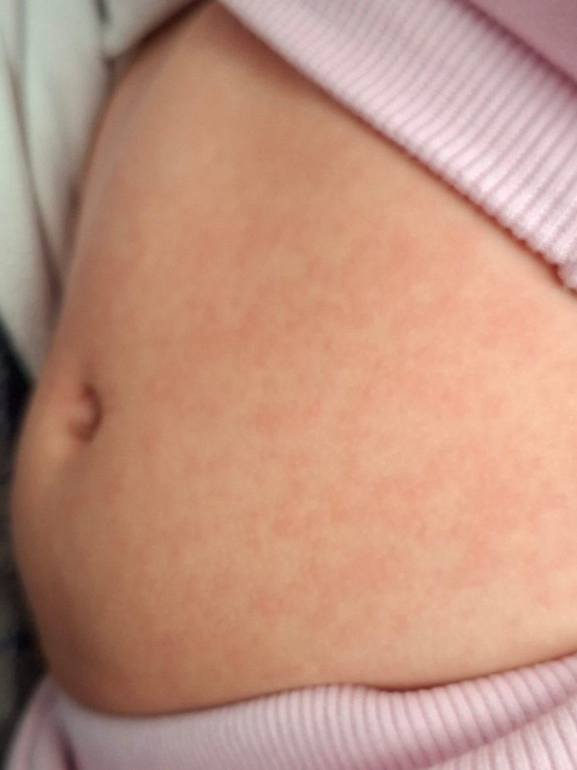 Sintomas começam como um resfriado comum (Foto Raisa Carvalho FolhaBV) Sintomas começam como um resfriado comum (Foto Raisa Carvalho FolhaBV)