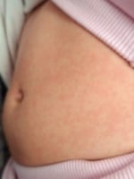 Sintomas começam como um resfriado comum (Foto Raisa Carvalho FolhaBV)