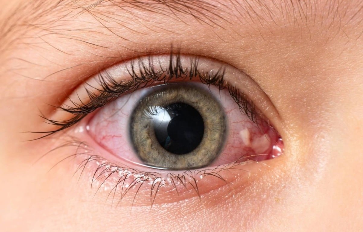 Olhos vermelhos por tempo prolongado podem causar danos na córnea (Foto: Reprodução)