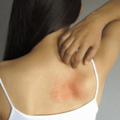 Coceira e lesões que não saram podem ser sinais de doenças autoimunes (Foto: Reprodução)