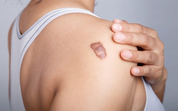 Casos de queloide são mais comuns em pele negra (Foto: Reprodução)