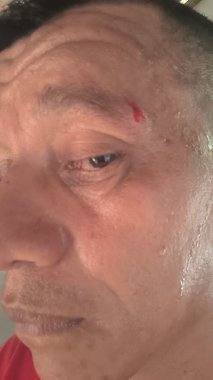 De Kaprio exibiu região do supercílio que teria sido agredida pelo vereador Júnior Paraíba (Foto: Divulgação)