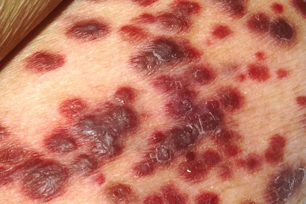 Sarcoma de Kaposi: Entenda o raro câncer ligado ao HIV