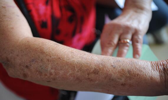 Campanha alerta para a importância da prevenção ao câncer de pele (Foto: Divulgação)