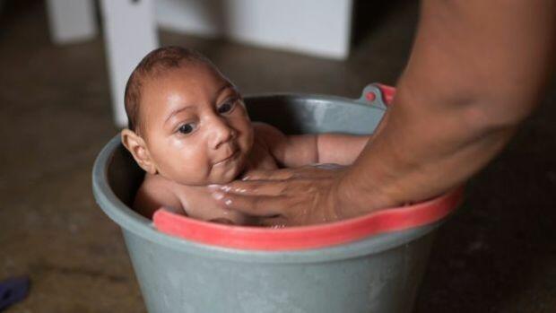 Microcefalia é uma das doenças transmitidas pelo vírus (Foto: Divulgação)