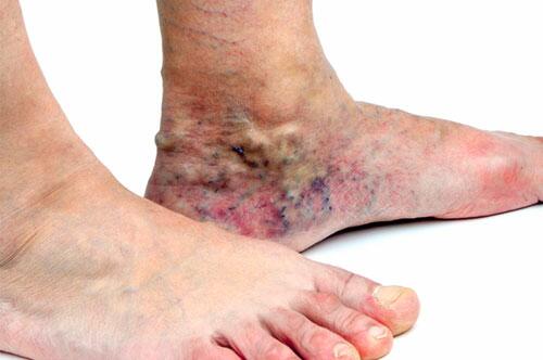 Doença ocorre pela má-formação de coágulos nas veias da perna e no coração (Foto: Divulgação)
