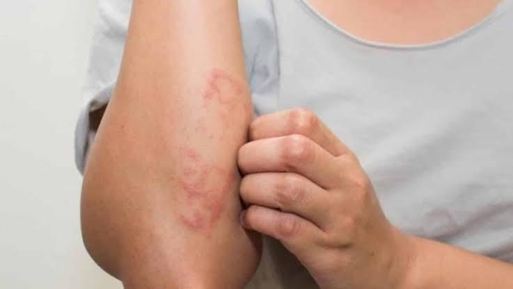 Infectocontagiosa, a hanseníase é causada por uma bactéria e pode provocar, entre os sintomas mais comuns, alterações na pele, como manchas brancas, avermelhadas ou escurecidas (Foto: Divulgação)