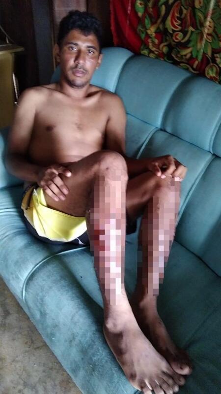 As pernas de Júnior estão inchadas, com bolhas e buracos que saem secreções (Foto: Divulgação)