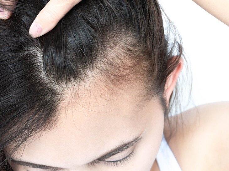 Uma queixa específica vem sendo relatada por mulheres e homens que tiveram a covid: a queda de cabelo (Foto: Divulgação)