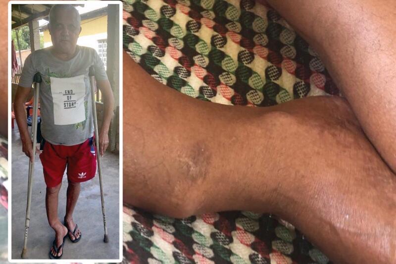 Acidente causou danos à perna direita do aposentado (Foto: Divulgação/Montagem)