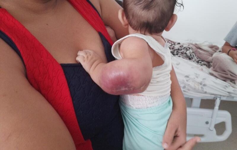 A ferida que se parecia com uma picada de mosquito, hoje está em quadro bem avançado e ainda não tem um diagnóstico (Foto: Arquivo pessoal)